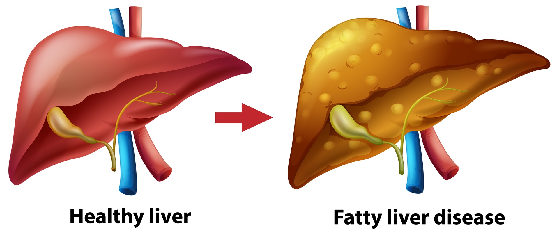 Nonalcoholic Fatty Liver Disease