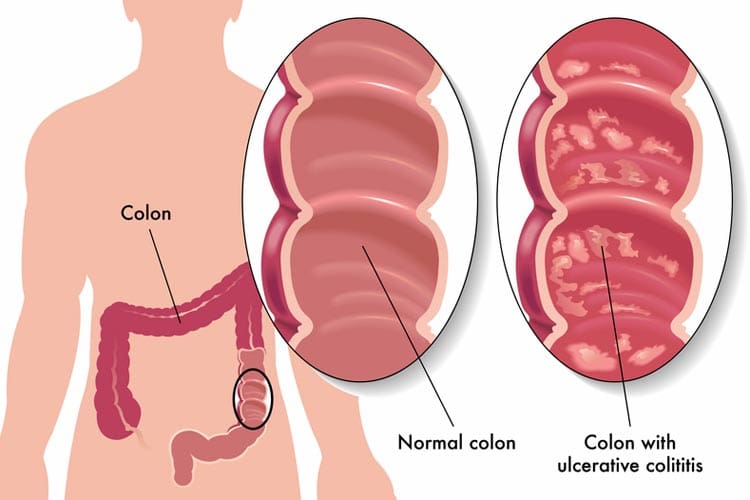 ulcerative_colitis_750