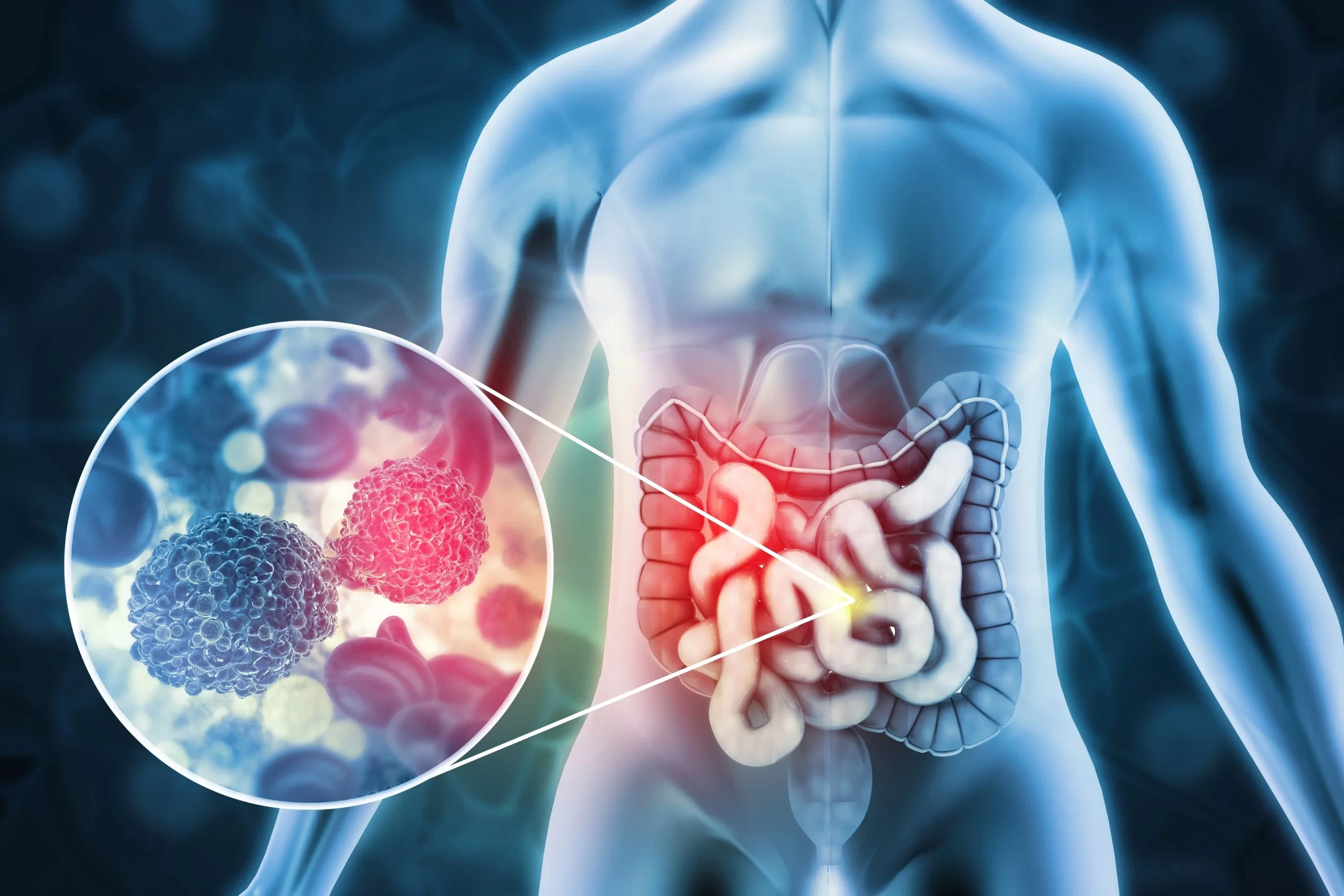 Colon cancer illustration